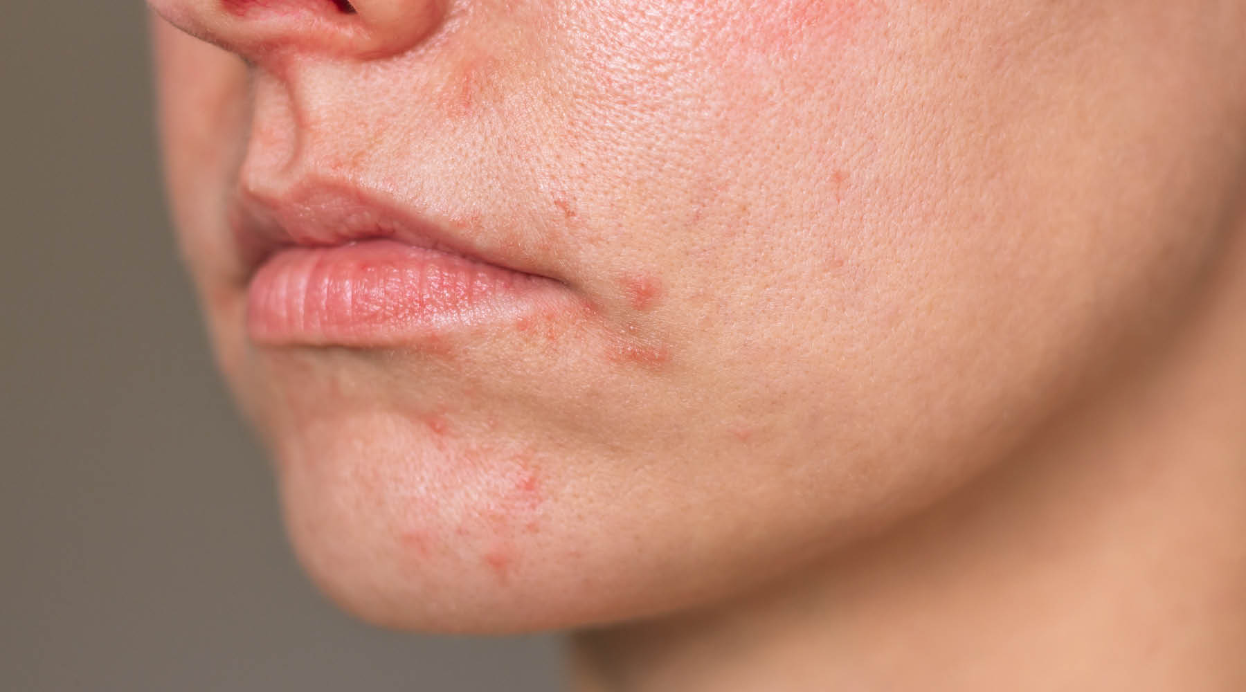 Perioral Dermatitis vs Acne: Why Treating It Like Pimples Will Make It Worse