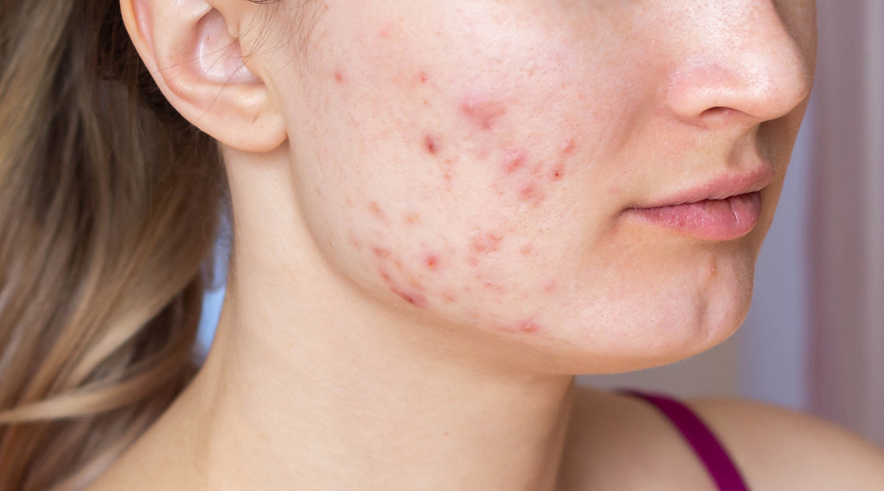 Why Your Skin Gets Worse Before It Gets Better: The Science of Acne Purging and Clearing