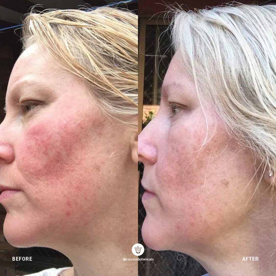 Rosacea Routine