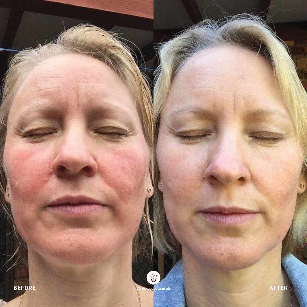 Rosacea Routine